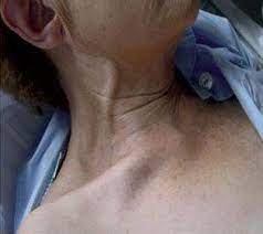 Aumento de la presión yugular secundario a cor pulmonale