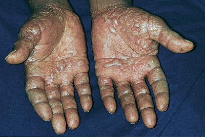 Pompholyx, dermatitis vesiculobullosa o dishidrosis