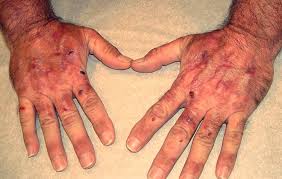 Porfiria cutánea tarda