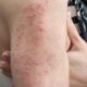 Dermatitis herpetiforme