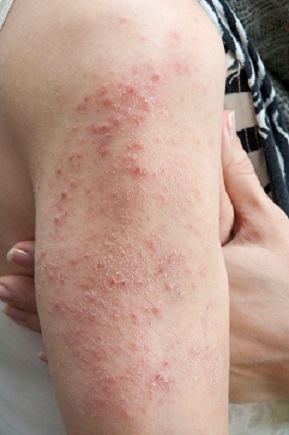 Dermatitis herpetiforme