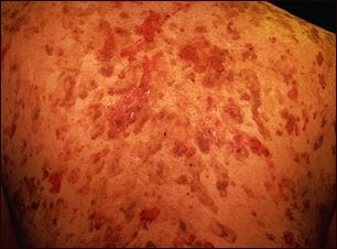 El pénfigo se caracteriza por formar ampollas intradérmicas