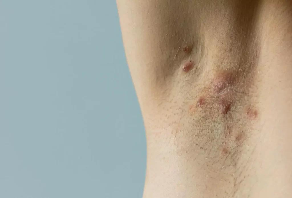 Hidradenitis supurativa