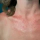 Fotodermatitis