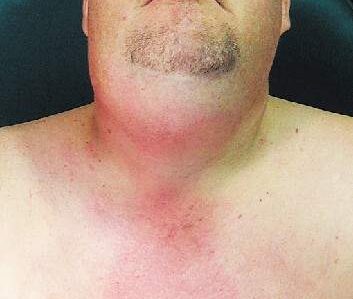 Abscesos profundos del cuello