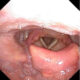 Epiglotitis