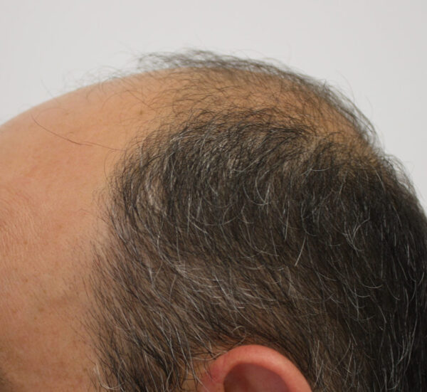Alopecia
