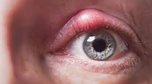 ¿Qué es el chalazión?