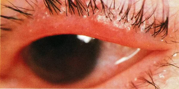 ¿Qué es la blefaritis?