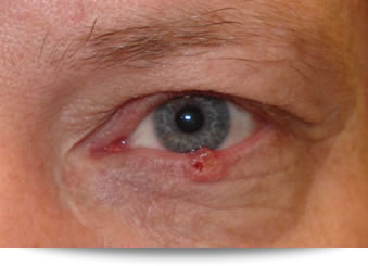 Tumores de los párpados