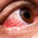 ¿Qué es la conjuntivitis?