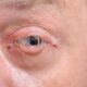 Conjuntivitis bacteriana