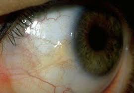 ¿Qué es la pingüécula?