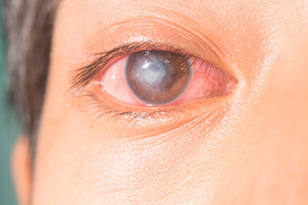 ¿Qué son las úlceras corneales?