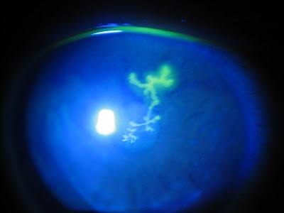 Queratitis por herpes simple