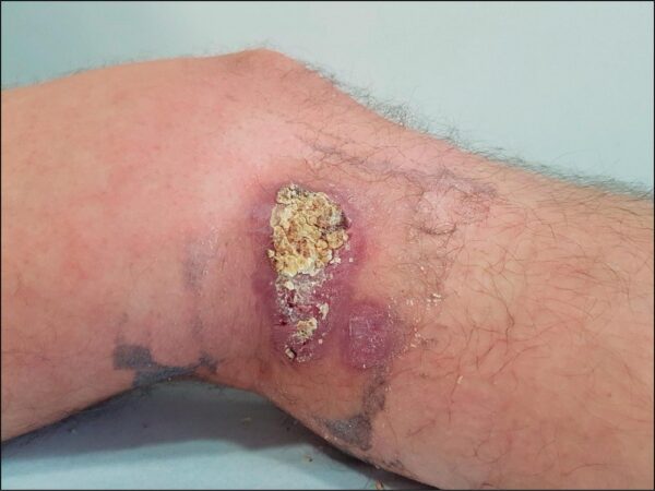 ¿Qué síndromes causan los protozoarios del género Leishmania?