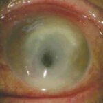 ¿Qué es la queratitis fúngica?