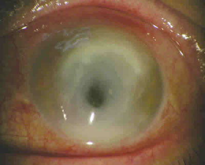 ¿Qué es la queratitis fúngica?