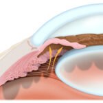 Glaucoma agudo de ángulo cerrado