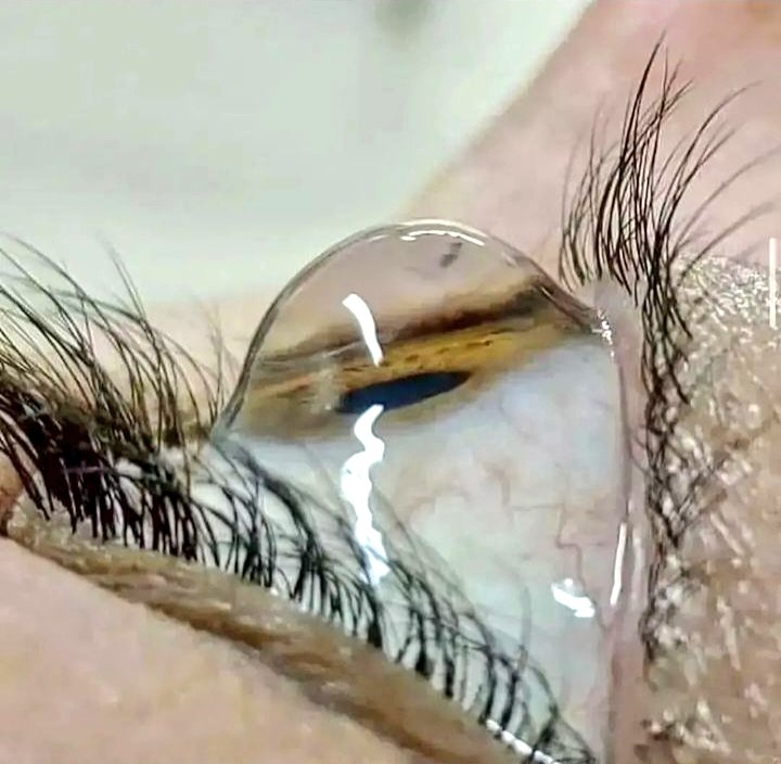 ¿Qué es el queratocono?