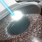 Terapia y cirugía con láser para el glaucoma crónico