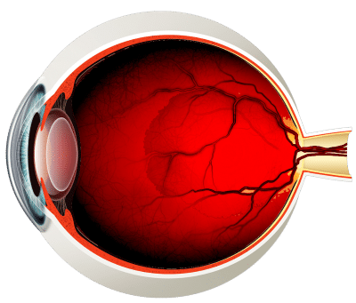 ¿Qué es la hemorragia vítrea?