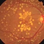 Degeneración macular relacionada con la edad
