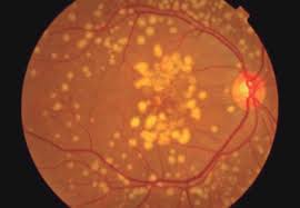 Degeneración macular relacionada con la edad