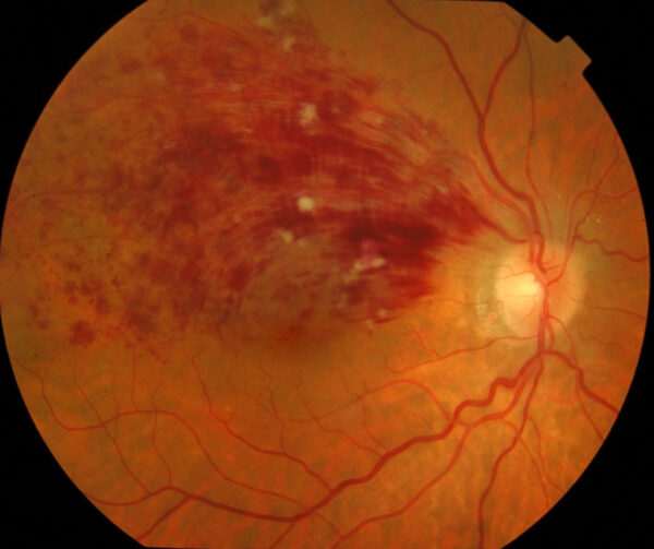 Oclusión de la vena retiniana central