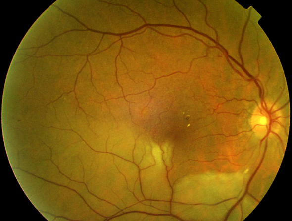 Oclusión de la arteria central de la retina