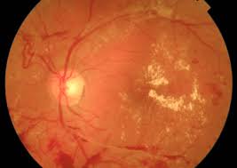 Retinopatía diabética