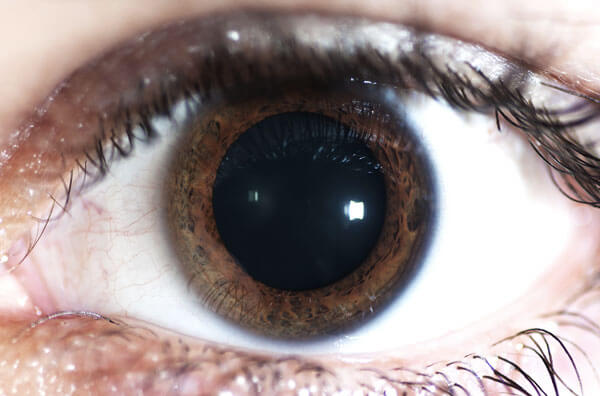 La dilatación de la pupila puede precipitar glaucoma