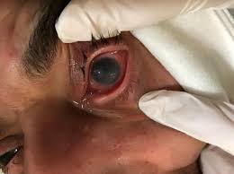 Conjuntivitis y queratitis química