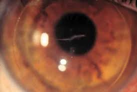 Laceraciones de la Conjuntiva, córnea y esclerótica