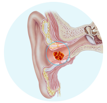 Impactación de cerumen