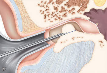 Exostosis y osteomas