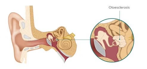 ¿Qué es la otosclerosis?