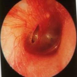 Traumatismo del oído medio