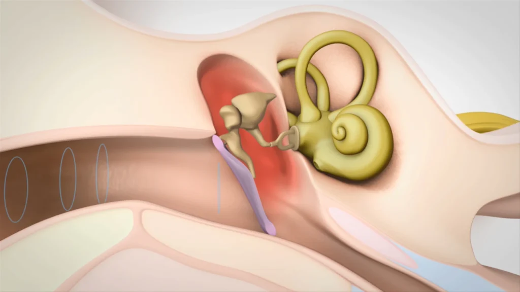 Pérdida auditiva neurosensorial