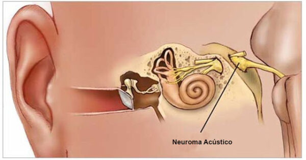 Schwannoma Vestibular (Neuroma Acústico)