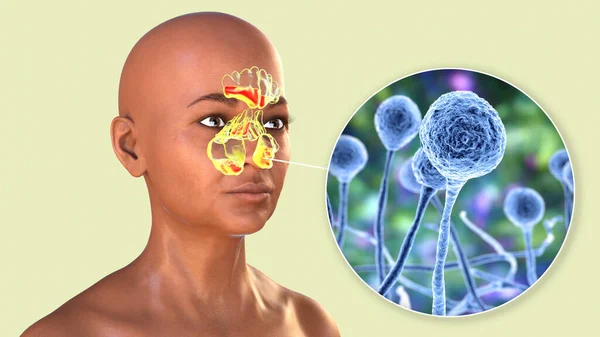 Sinusitis fúngica invasiva