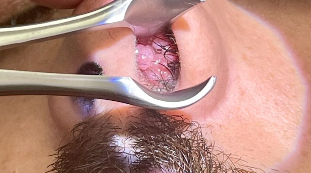 Papilomas invertidos o papilomas nasales