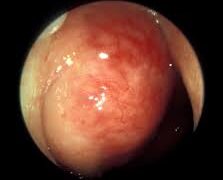 Tumores nasofaríngeos y paranasales malignos