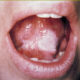 leucoplasia