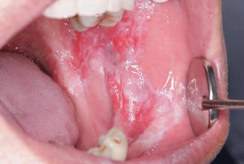 ¿Qué es el liquen plano oral?