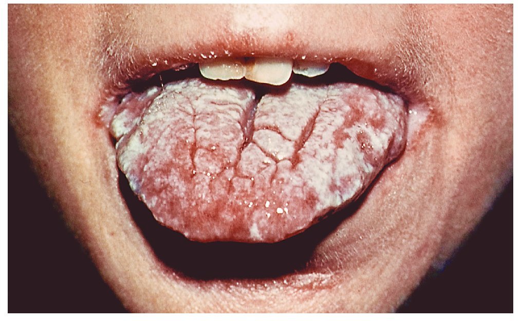 Candidiasis oral