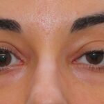 La parálisis de nervios craneales puede afectar los ojos