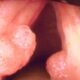 Papilomatosis Respiratoria