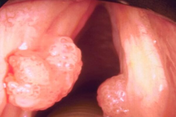 Papilomatosis Respiratoria