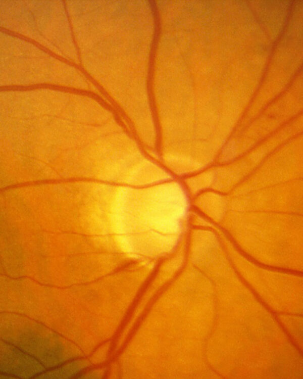 Protuberancia del disco óptico